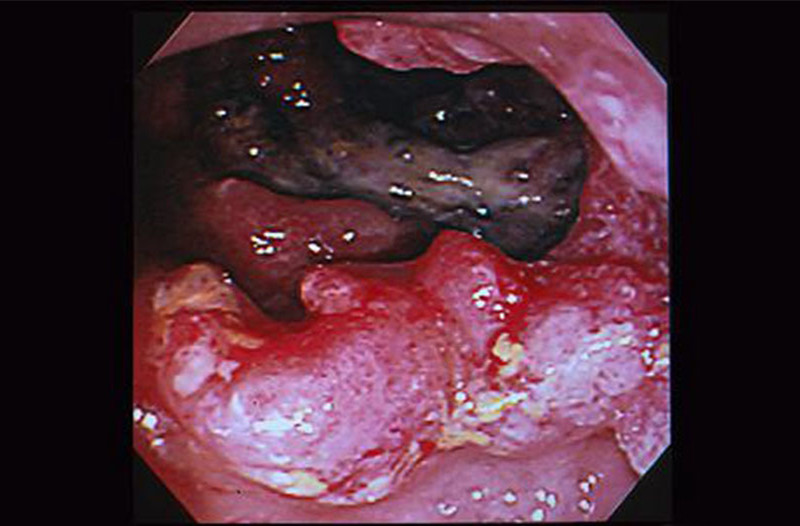 肠道颗粒细胞瘤图片