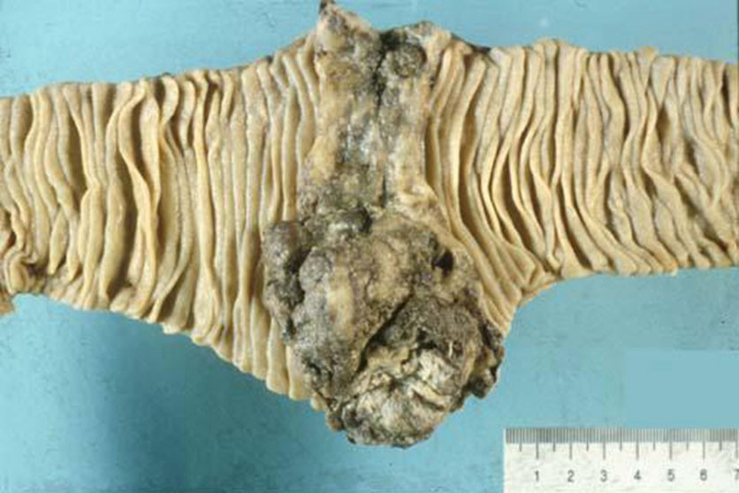 十二指肠肿瘤部位图