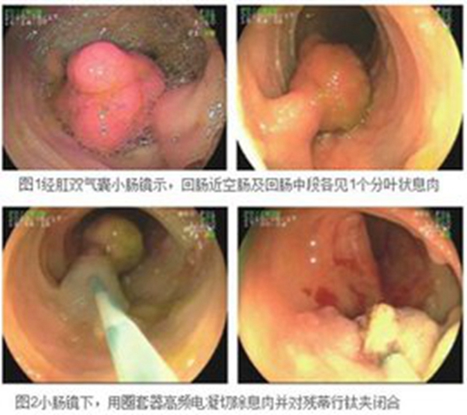 肠肿瘤图片_肠肿瘤症状表现图片大全_有来医生
