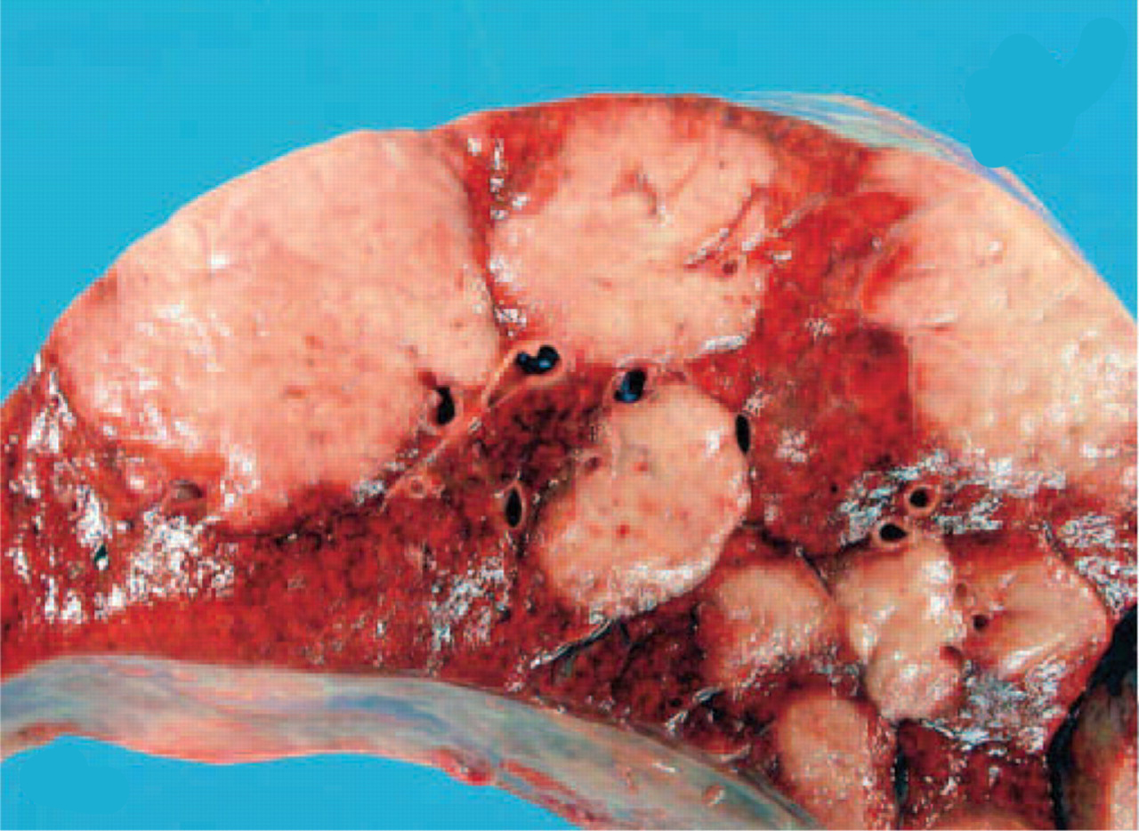 肺纤维化早期图片