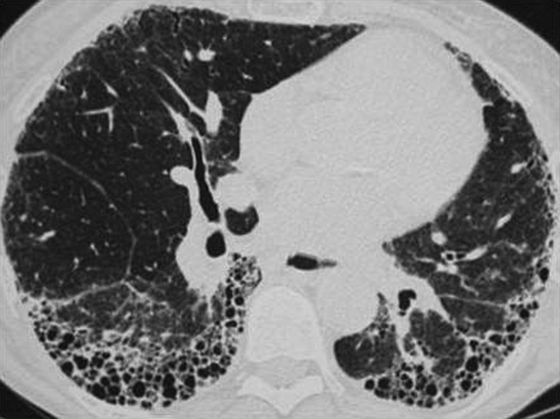 肺纤维化ct影像学表现图片