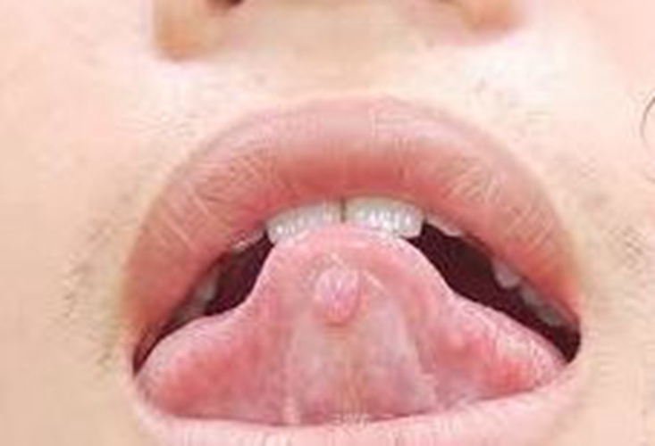 舌系带粘液囊肿图片图片