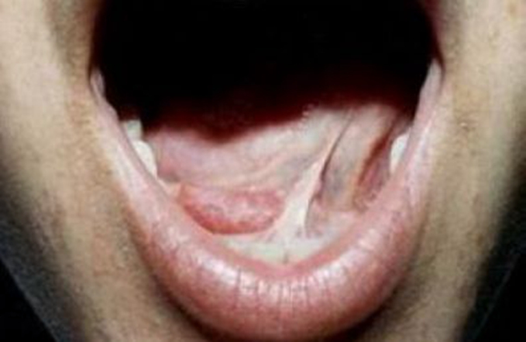 舌下腺肿瘤 恶性图片