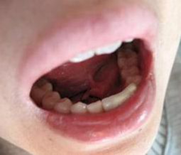 舌下腺囊肿淋巴肿大图片