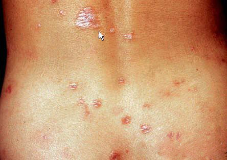 女性梅毒疹图片 二期图片