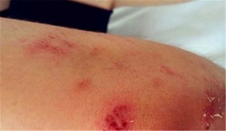 白塞病肩部图片