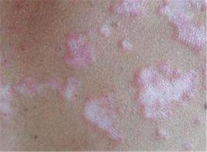 白塞病白块症状图片