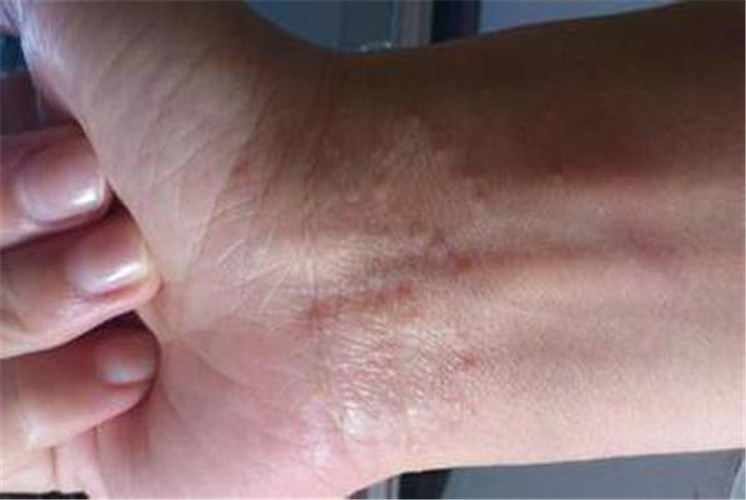 白塞氏病图片_白塞氏病症状表现图片大全_有来医生