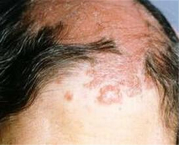 白塞氏病图片_白塞氏病症状表现图片大全_有来医生