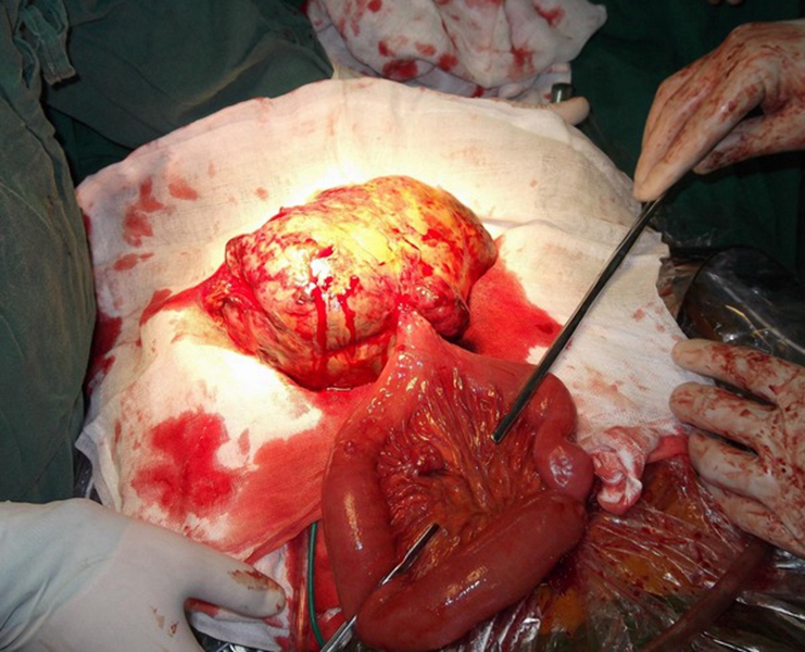 结肠直肠腺瘤图片