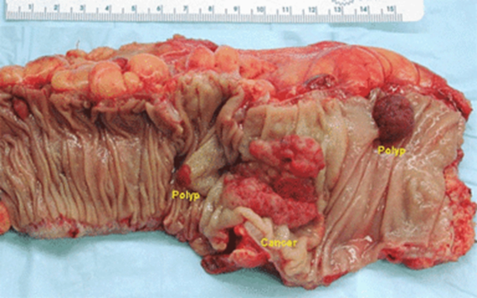 小肠癌图片