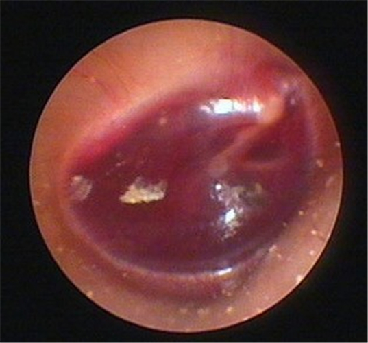 鼓膜穿孔图片_鼓膜穿孔症状表现图片大全_有来医生