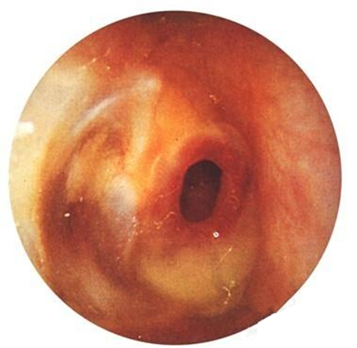 儿童鼓膜穿孔图片