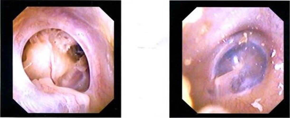 鼓膜穿孔症状图片