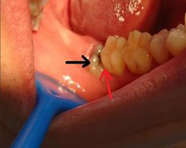 水平智齿阻生牙图片