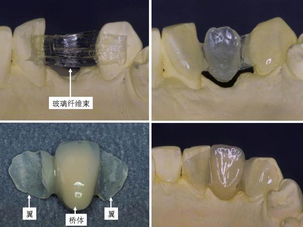 缺一顆牙就補一顆牙的粘接橋技術