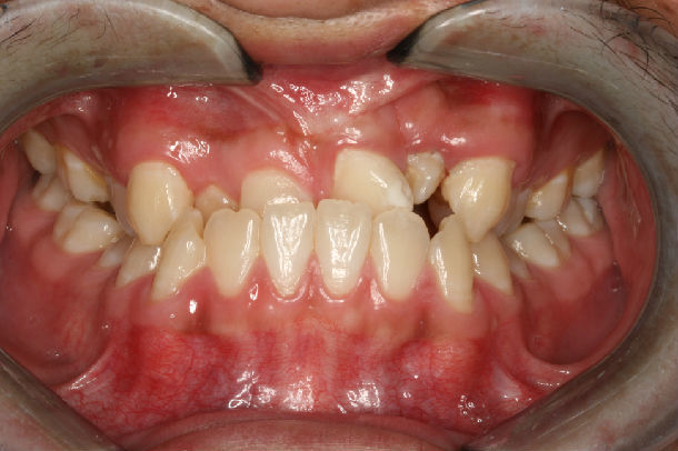 唇腭裂患者正畸治疗效果