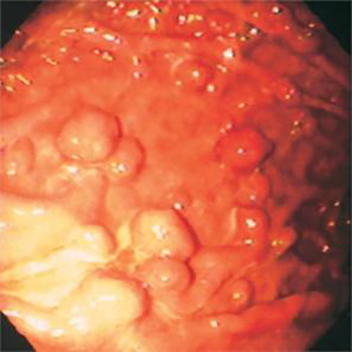 胃息肉癌变前兆图片图片