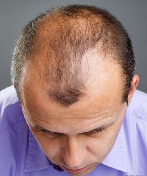 额头两侧脱发的图片