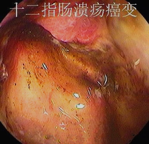 十二指肠溃疡a1期癌变图片