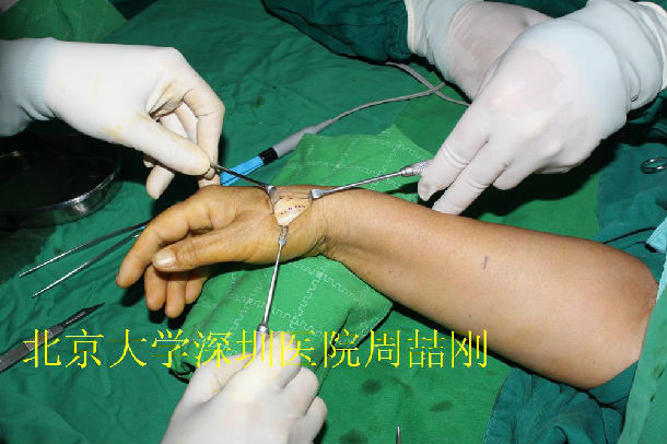 第一腕掌关节炎的手术治疗(附手术过程图片)