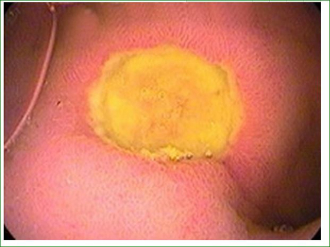 十二指肠溃疡球部早期症状图片
