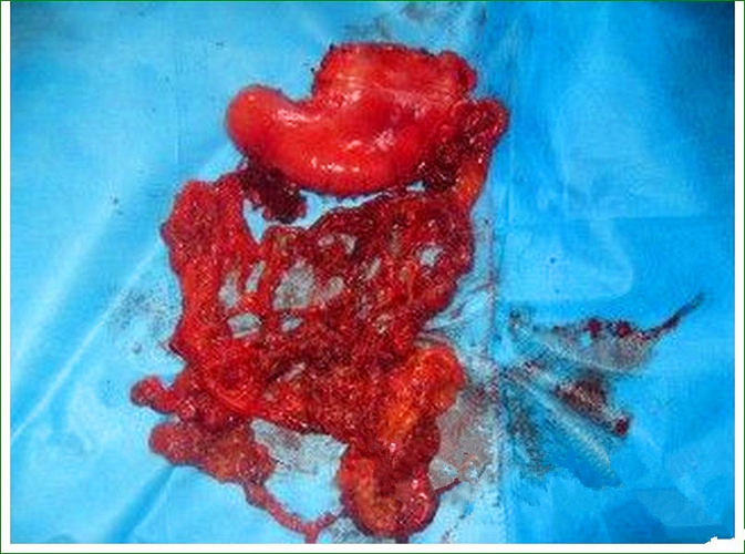 胃溃疡标本图片图片