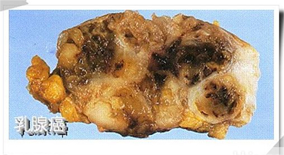 乳腺癌图片大全 恶性图片
