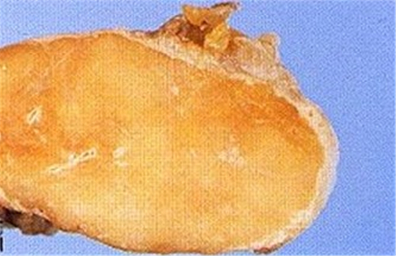 乳腺纤维腺瘤大体标本图片