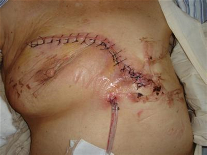 乳腺纤维瘤割下的图片图片