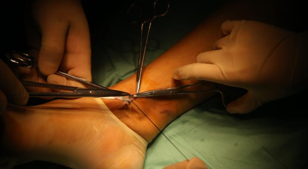 下肢静脉曲张手术刀口图片