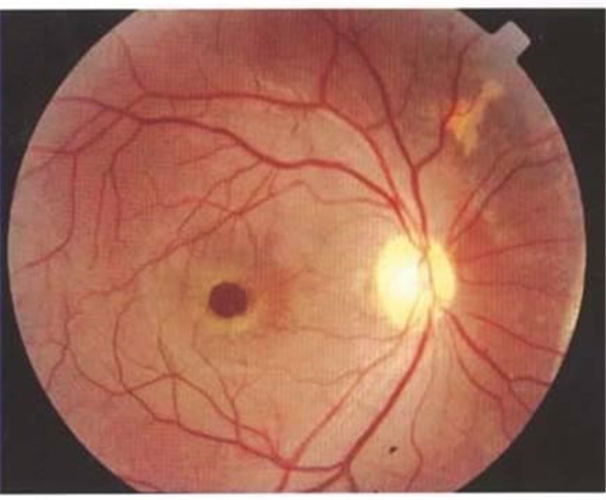 黄斑裂孔性视网膜脱落图片
