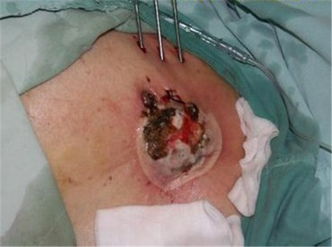 乳腺癌的早期症状图图片