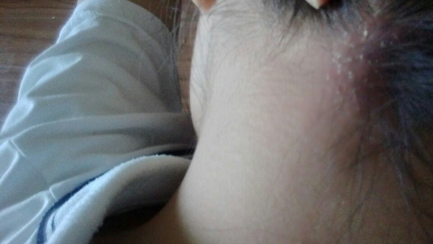 头部银屑病与头癣图片