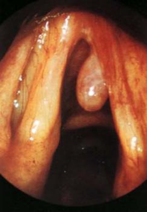 喉咙咳出一块息肉图片图片
