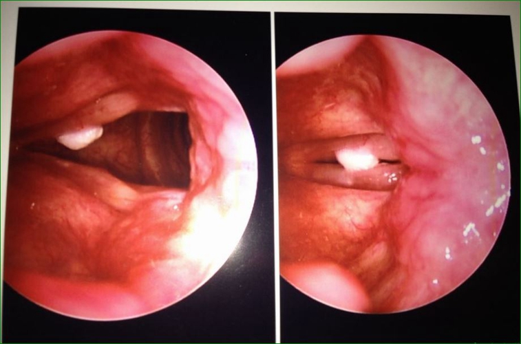 咽喉息肉图片早期图片