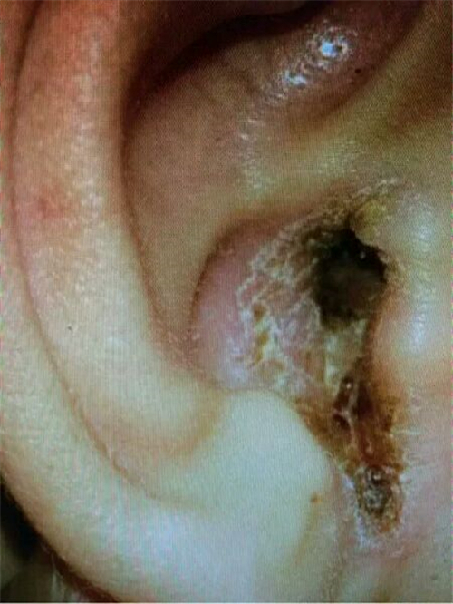 急性中耳炎外耳症状图片