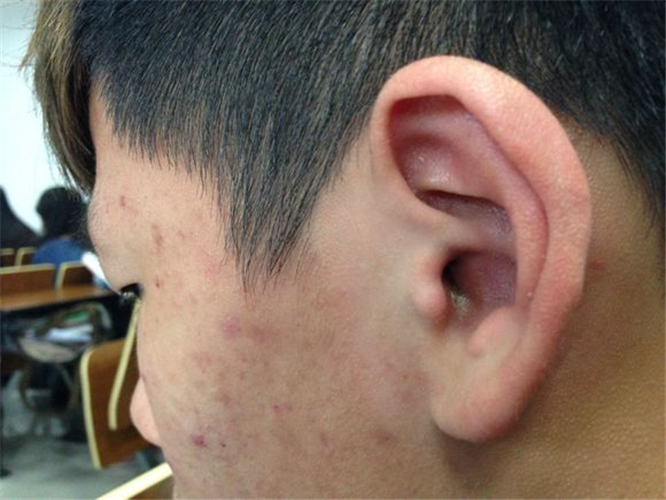 男性急性中耳炎耳朵图片
