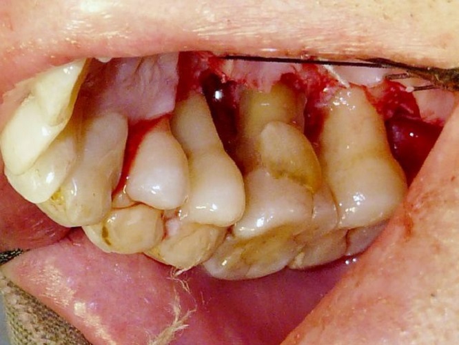 牙周炎的图片及症状图片