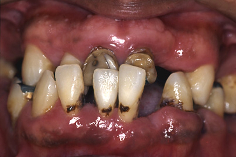 牙周炎的症状表现图片