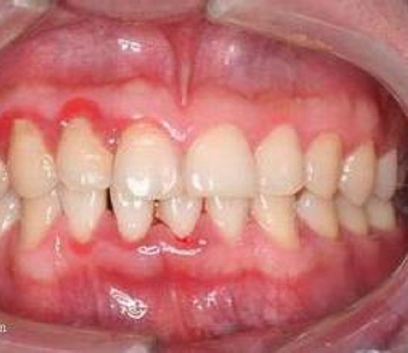 慢性牙周炎轻微症状图片