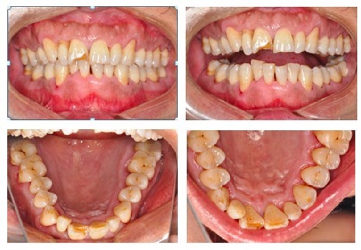 牙周炎症状图片 对比图片