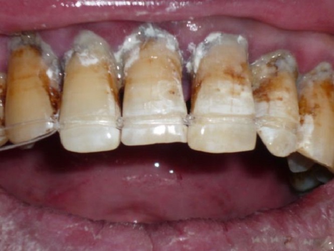 牙周病晚期图片