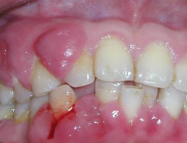 牙周炎图片症状图片图片