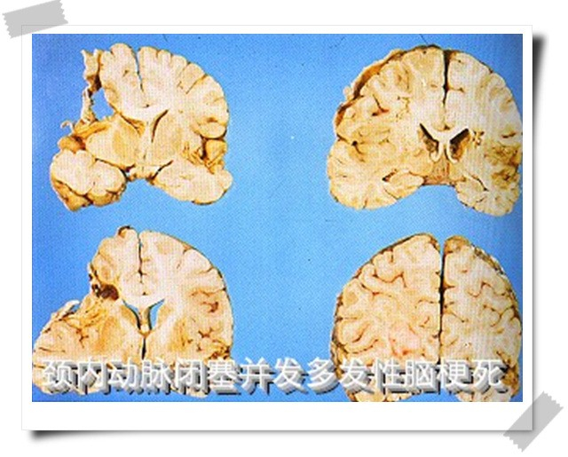 颈内动脉闭塞并发脑梗塞图片