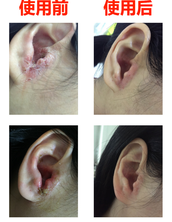 急性中耳炎治疗前后对比图片