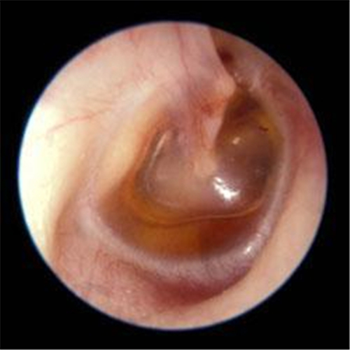 男性秋季急性中耳炎鼓膜图片