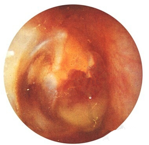 女性急性中耳炎的鼓膜图片