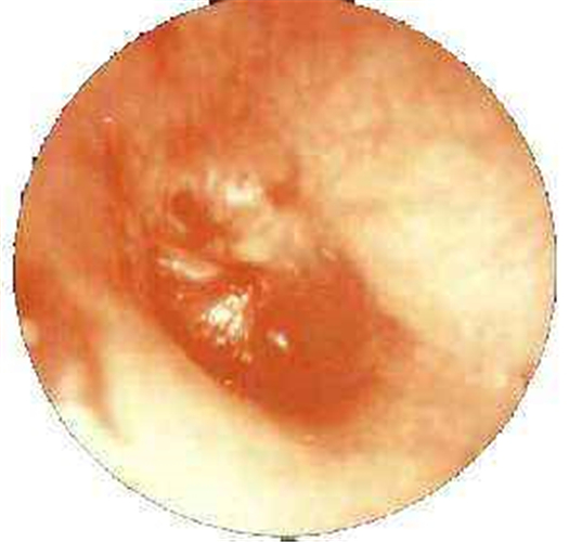 化脓性急性中耳炎鼓膜图片