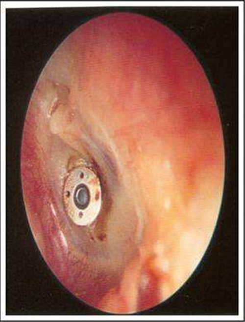 冬季急性中耳炎鼓膜图片